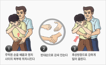 1.주먹쥔 손을 배꼽과 명치 사이의 복부에 위치시킨다 2.반대손으로 감싸 안는다 3.후상방향으로 강하게 밀어 올린다.