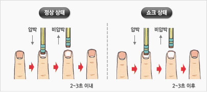 정상상태-2-3초 이내/ 쇼크상태-2-3초 이후